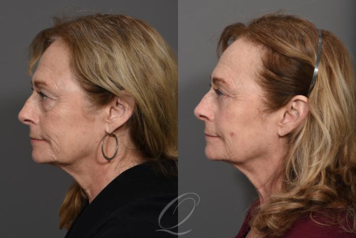 Eyelid Lift Case 1415 Before & After Left Side | Serving Rochester, Syracuse & Buffalo, NY | Quatela Center for Plastic Surgery