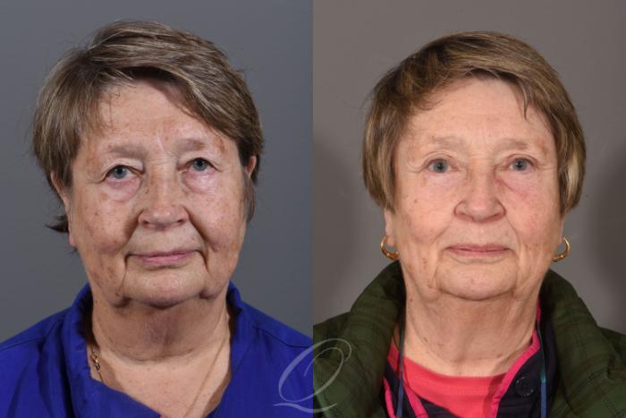 Eyelid Lift Case 1419 Before & After Front | Serving Rochester, Syracuse & Buffalo, NY | Quatela Center for Plastic Surgery