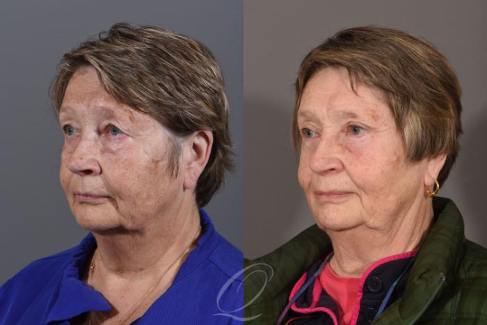 Eyelid Lift Case 1419 Before & After Left Oblique | Serving Rochester, Syracuse & Buffalo, NY | Quatela Center for Plastic Surgery