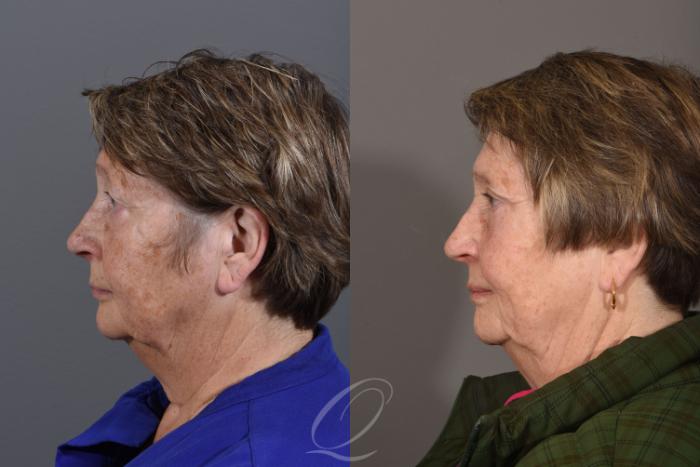 Eyelid Lift Case 1419 Before & After Left Side | Serving Rochester, Syracuse & Buffalo, NY | Quatela Center for Plastic Surgery
