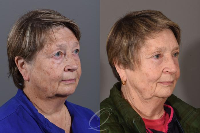 Eyelid Lift Case 1419 Before & After Right Oblique | Serving Rochester, Syracuse & Buffalo, NY | Quatela Center for Plastic Surgery