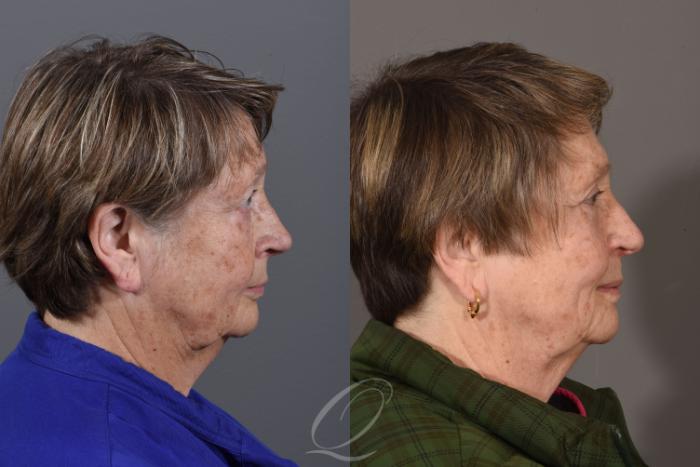 Eyelid Lift Case 1419 Before & After Right Side | Serving Rochester, Syracuse & Buffalo, NY | Quatela Center for Plastic Surgery