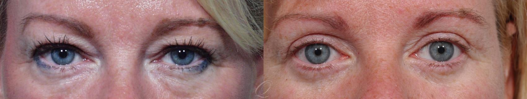 Eyelid Lift Case 142 Before & After View #1 | Serving Rochester, Syracuse & Buffalo, NY | Quatela Center for Plastic Surgery
