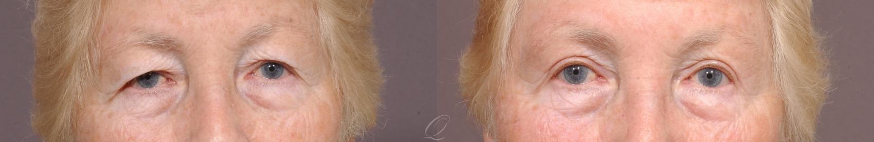 Eyelid Lift Case 143 Before & After View #1 | Serving Rochester, Syracuse & Buffalo, NY | Quatela Center for Plastic Surgery