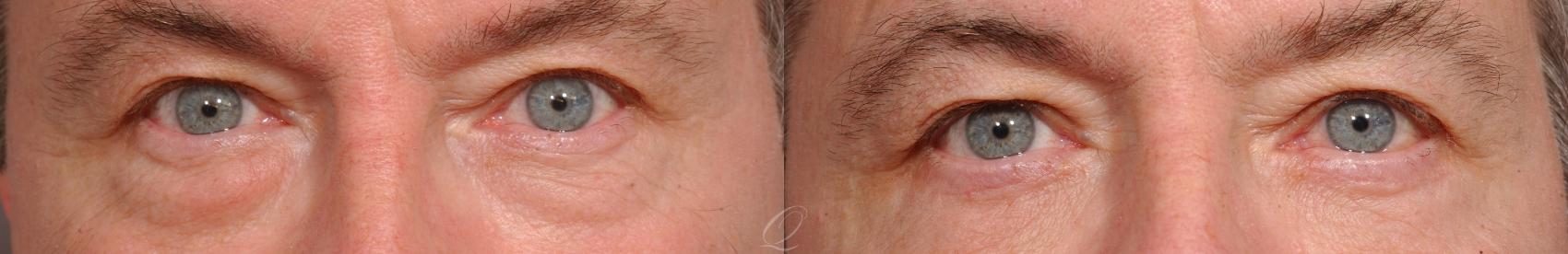 Eyelid Lift Case 144 Before & After View #1 | Serving Rochester, Syracuse & Buffalo, NY | Quatela Center for Plastic Surgery