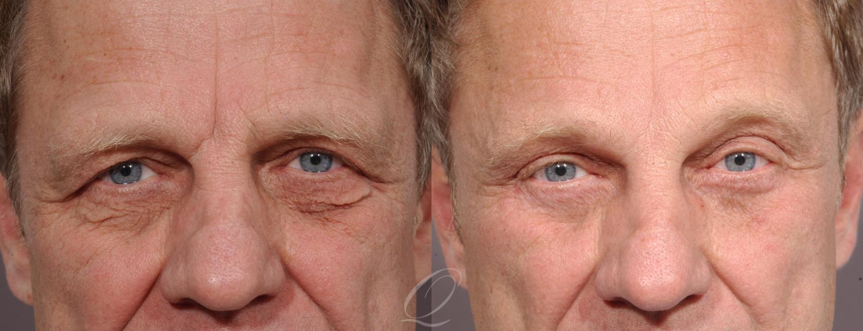 Eyelid Lift Case 293 Before & After View #1 | Serving Rochester, Syracuse & Buffalo, NY | Quatela Center for Plastic Surgery