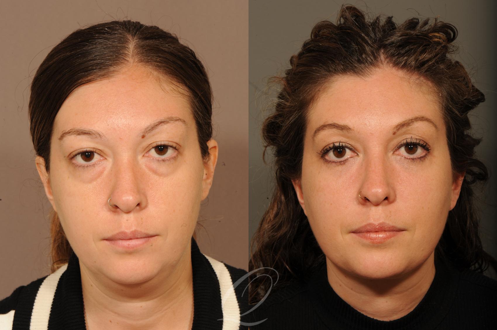 Eyelid Lift Case 316 Before & After View #1 | Serving Rochester, Syracuse & Buffalo, NY | Quatela Center for Plastic Surgery