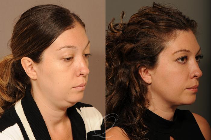 Eyelid Lift Before After Photos Patient 316 Serving Rochester