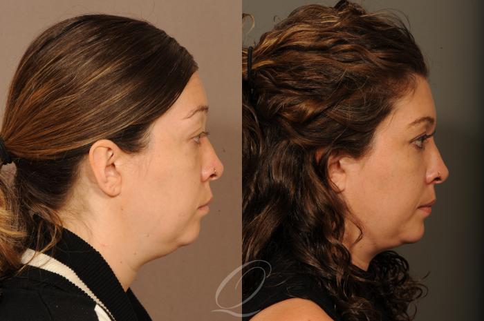 Neck Liposuction Case 316 Before & After View #3 | Serving Rochester, Syracuse & Buffalo, NY | Quatela Center for Plastic Surgery