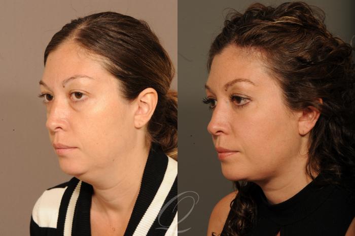 Eyelid Lift Case 316 Before & After View #4 | Serving Rochester, Syracuse & Buffalo, NY | Quatela Center for Plastic Surgery