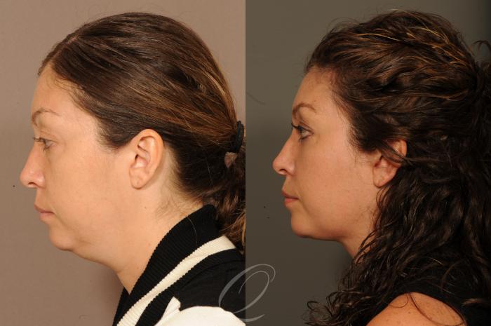 Neck Liposuction Case 316 Before & After View #5 | Serving Rochester, Syracuse & Buffalo, NY | Quatela Center for Plastic Surgery