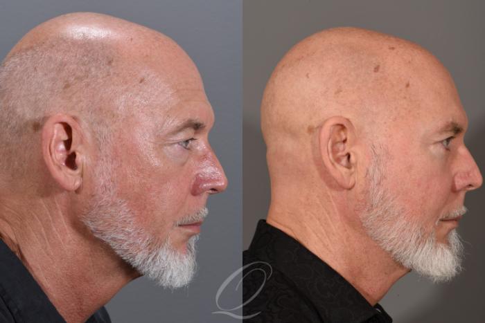 Eyelid Lift Case 409 Before & After Right Side | Serving Rochester, Syracuse & Buffalo, NY | Quatela Center for Plastic Surgery