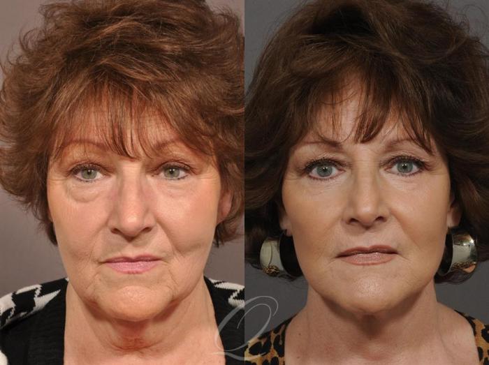 Facelift Case 1 Before & After View #1 | Serving Rochester, Syracuse & Buffalo, NY | Quatela Center for Plastic Surgery