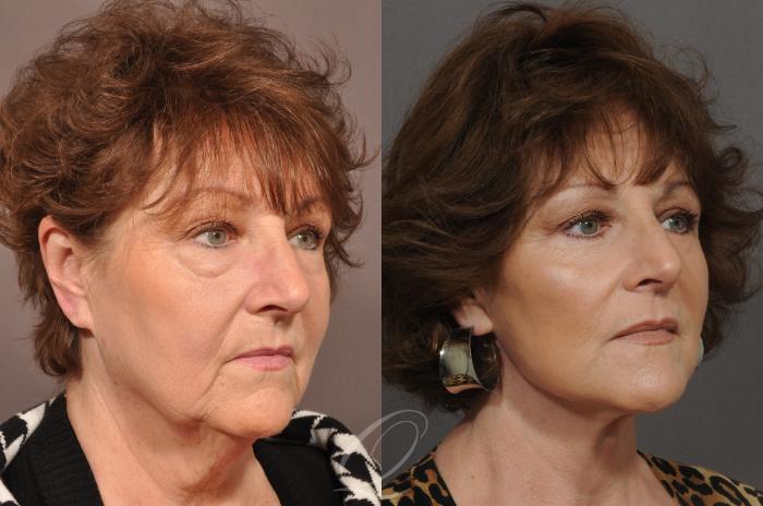 Facelift Case 1 Before & After View #2 | Serving Rochester, Syracuse & Buffalo, NY | Quatela Center for Plastic Surgery