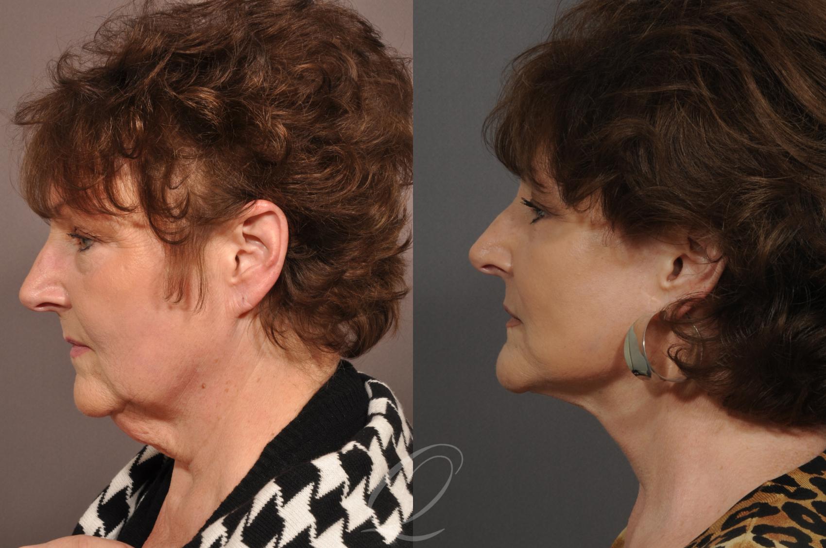 Facelift Case 1 Before & After View #3 | Serving Rochester, Syracuse & Buffalo, NY | Quatela Center for Plastic Surgery
