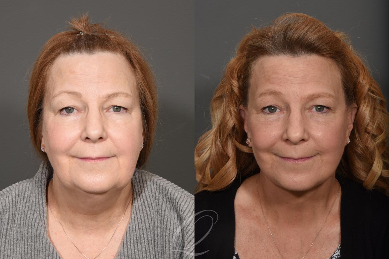 Neck Liposuction Case 1001247 Before & After View #1 | Serving Rochester, Syracuse & Buffalo, NY | Quatela Center for Plastic Surgery