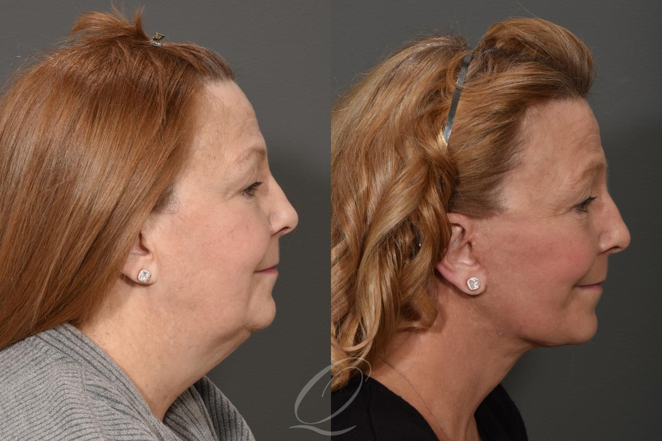 Facelift Case 1001247 Before & After View #3 | Serving Rochester, Syracuse & Buffalo, NY | Quatela Center for Plastic Surgery