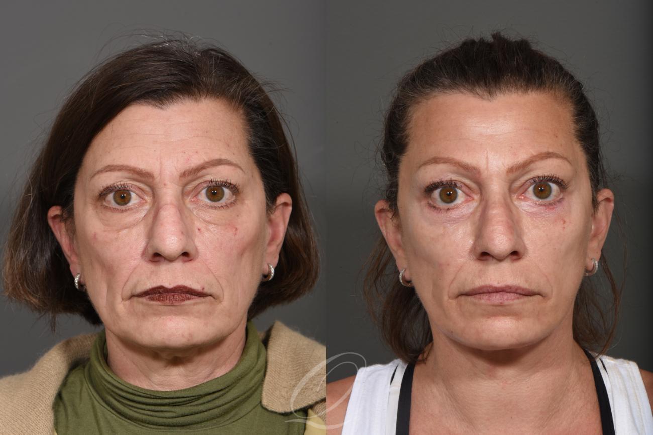 Facelift Case 336 Before & After View #1 | Serving Rochester, Syracuse & Buffalo, NY | Quatela Center for Plastic Surgery