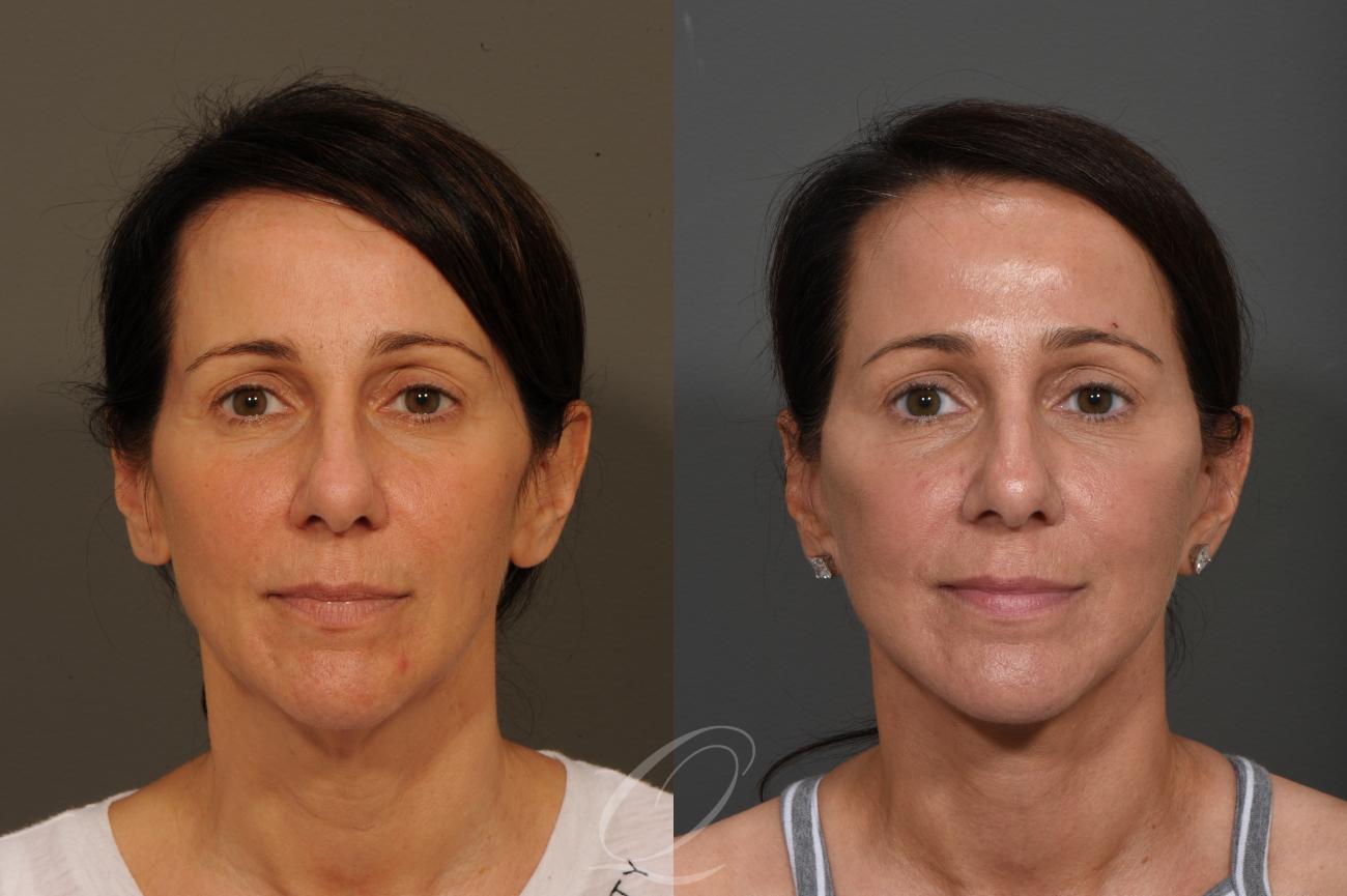 Fat Injections Case 349 Before & After View #1 | Serving Rochester, Syracuse & Buffalo, NY | Quatela Center for Plastic Surgery