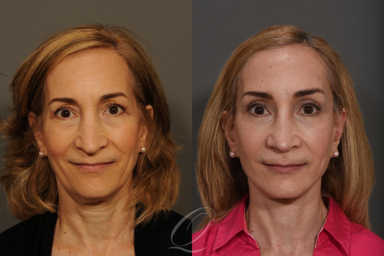 Revision Rhinoplasty Case 350 Before & After View #1 | Serving Rochester, Syracuse & Buffalo, NY | Quatela Center for Plastic Surgery