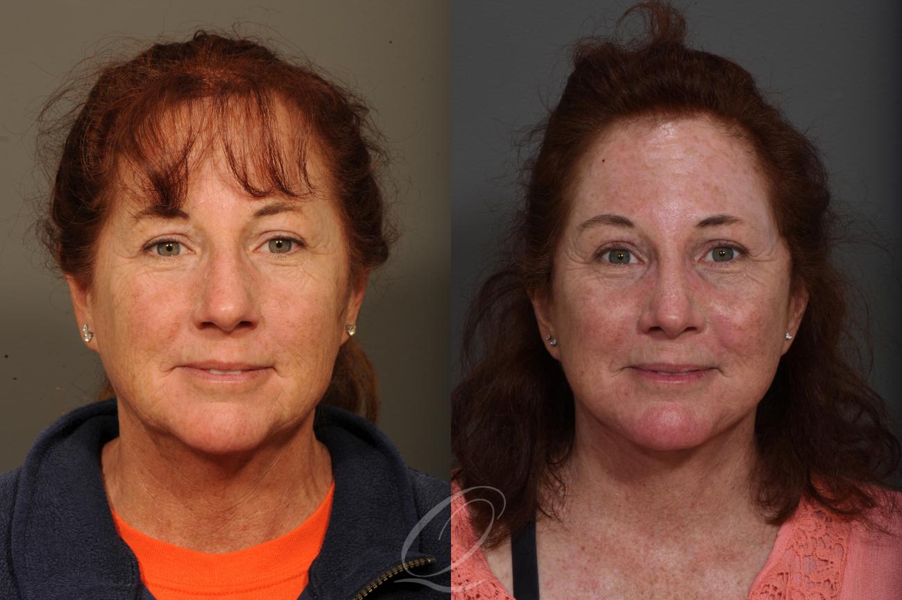 Facelift Case 351 Before & After View #1 | Serving Rochester, Syracuse & Buffalo, NY | Quatela Center for Plastic Surgery