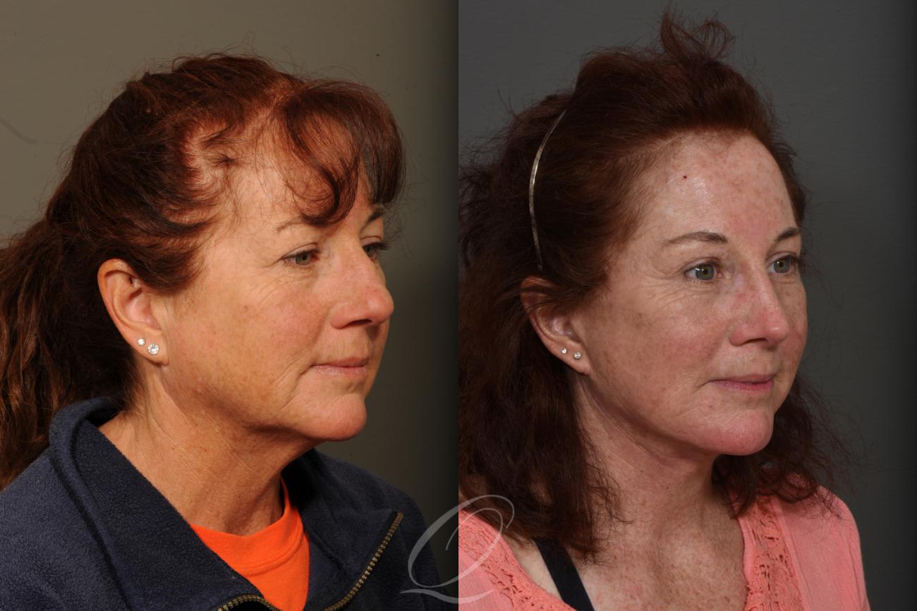 Facelift Case 351 Before & After View #2 | Serving Rochester, Syracuse & Buffalo, NY | Quatela Center for Plastic Surgery