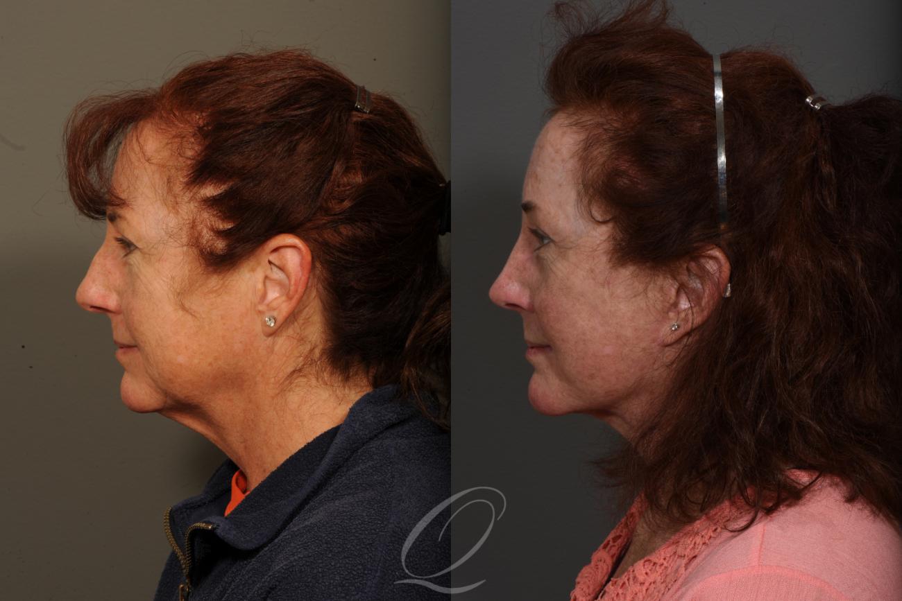 Facelift Case 351 Before & After View #3 | Serving Rochester, Syracuse & Buffalo, NY | Quatela Center for Plastic Surgery
