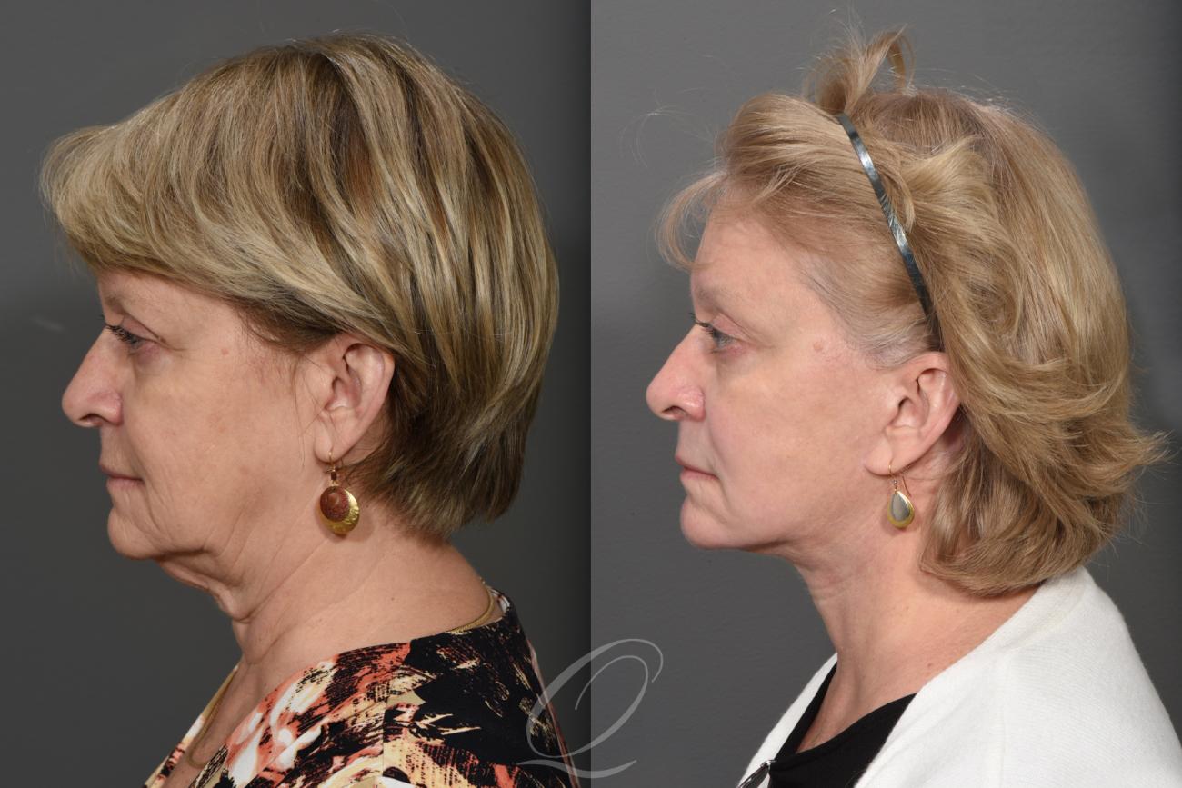 Skin Resurfacing Case 353 Before & After View #2 | Serving Rochester, Syracuse & Buffalo, NY | Quatela Center for Plastic Surgery