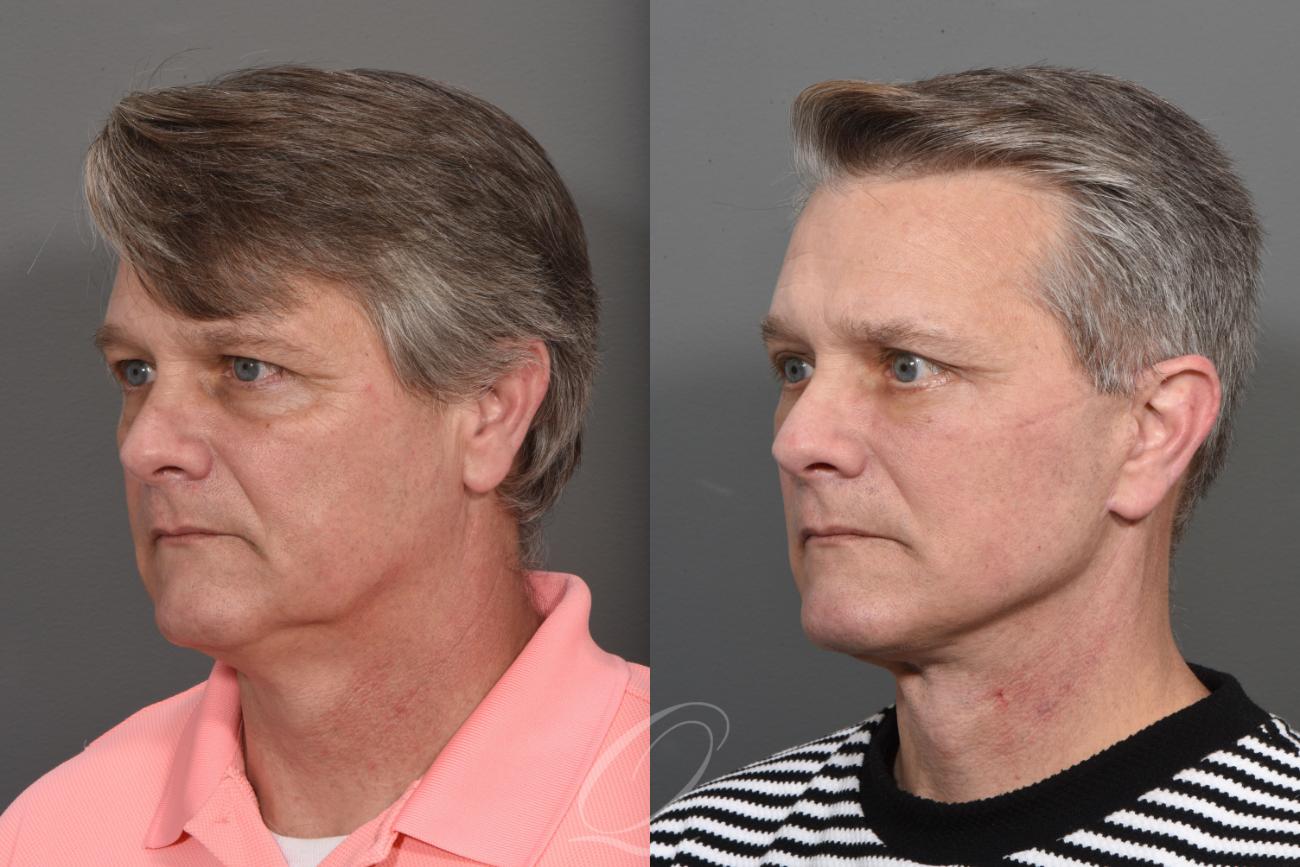 Facelift Case 1410 Before & After Left Oblique | Serving Rochester, Syracuse & Buffalo, NY | Quatela Center for Plastic Surgery