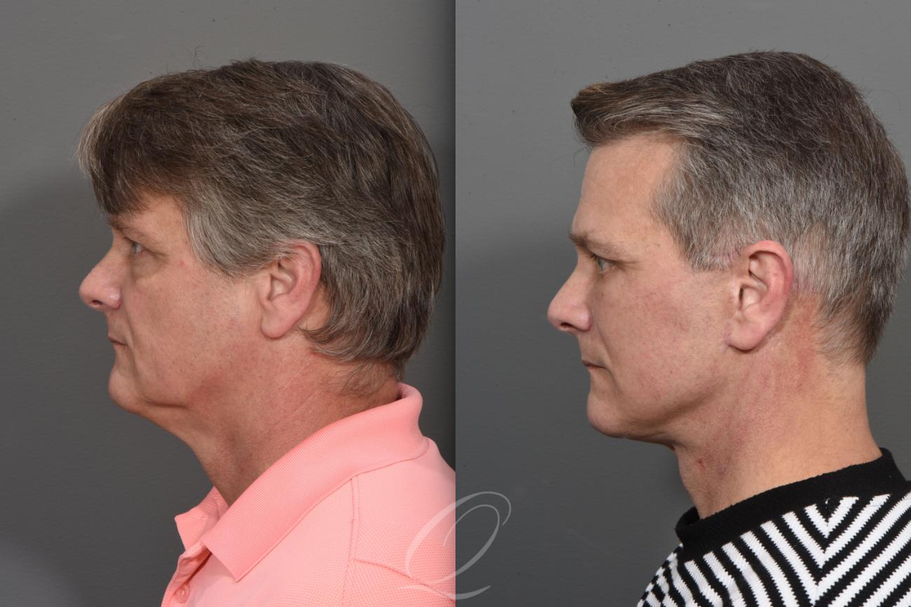 Facelift Case 1410 Before & After Left Side | Serving Rochester, Syracuse & Buffalo, NY | Quatela Center for Plastic Surgery