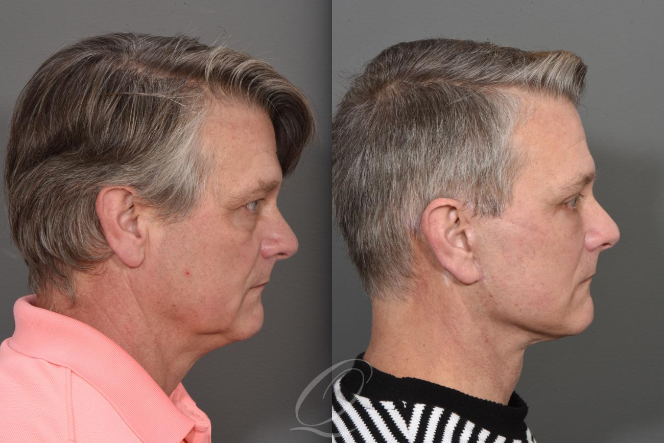 Facelift Case 1410 Before & After Right Side | Serving Rochester, Syracuse & Buffalo, NY | Quatela Center for Plastic Surgery