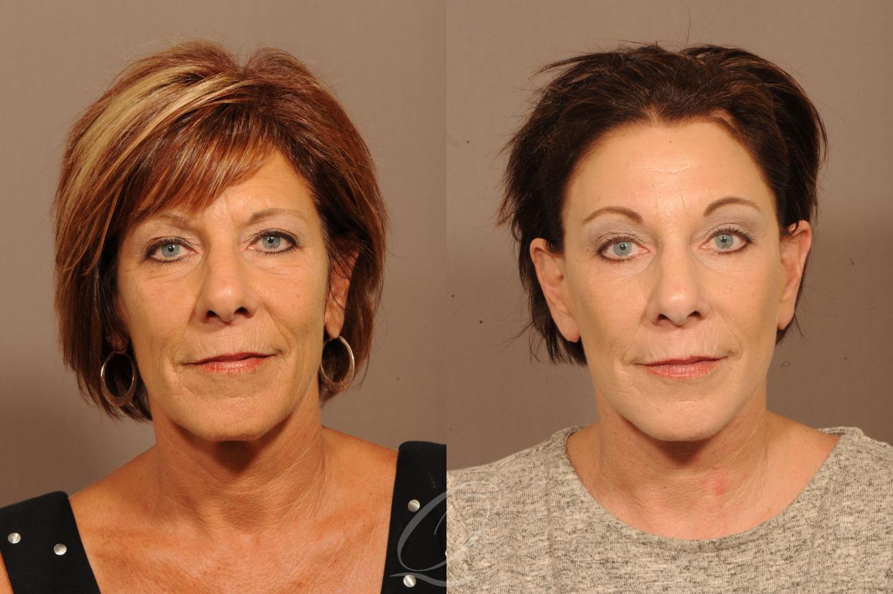 Skin Resurfacing Case 1411 Before & After Front | Serving Rochester, Syracuse & Buffalo, NY | Quatela Center for Plastic Surgery