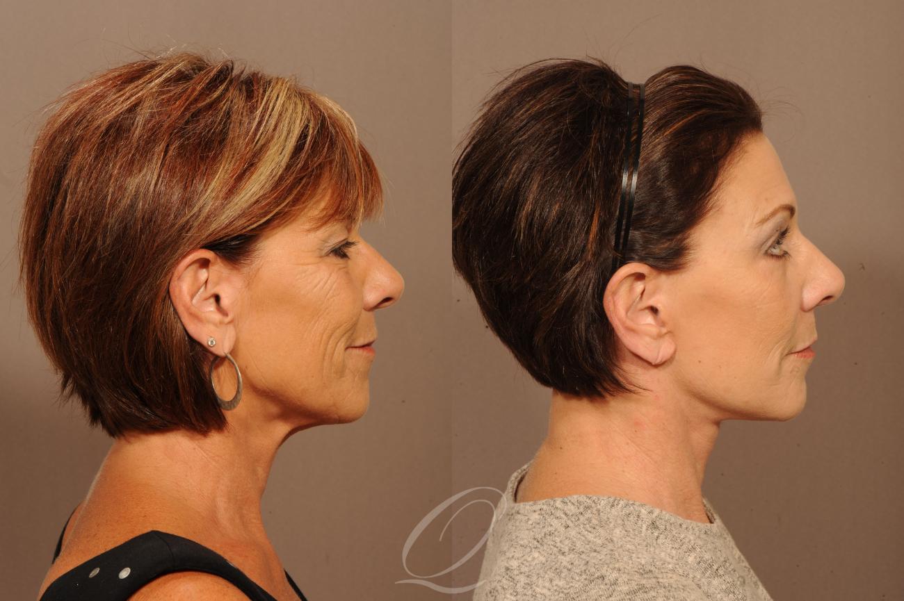 Skin Resurfacing Case 1411 Before & After Right Side | Serving Rochester, Syracuse & Buffalo, NY | Quatela Center for Plastic Surgery