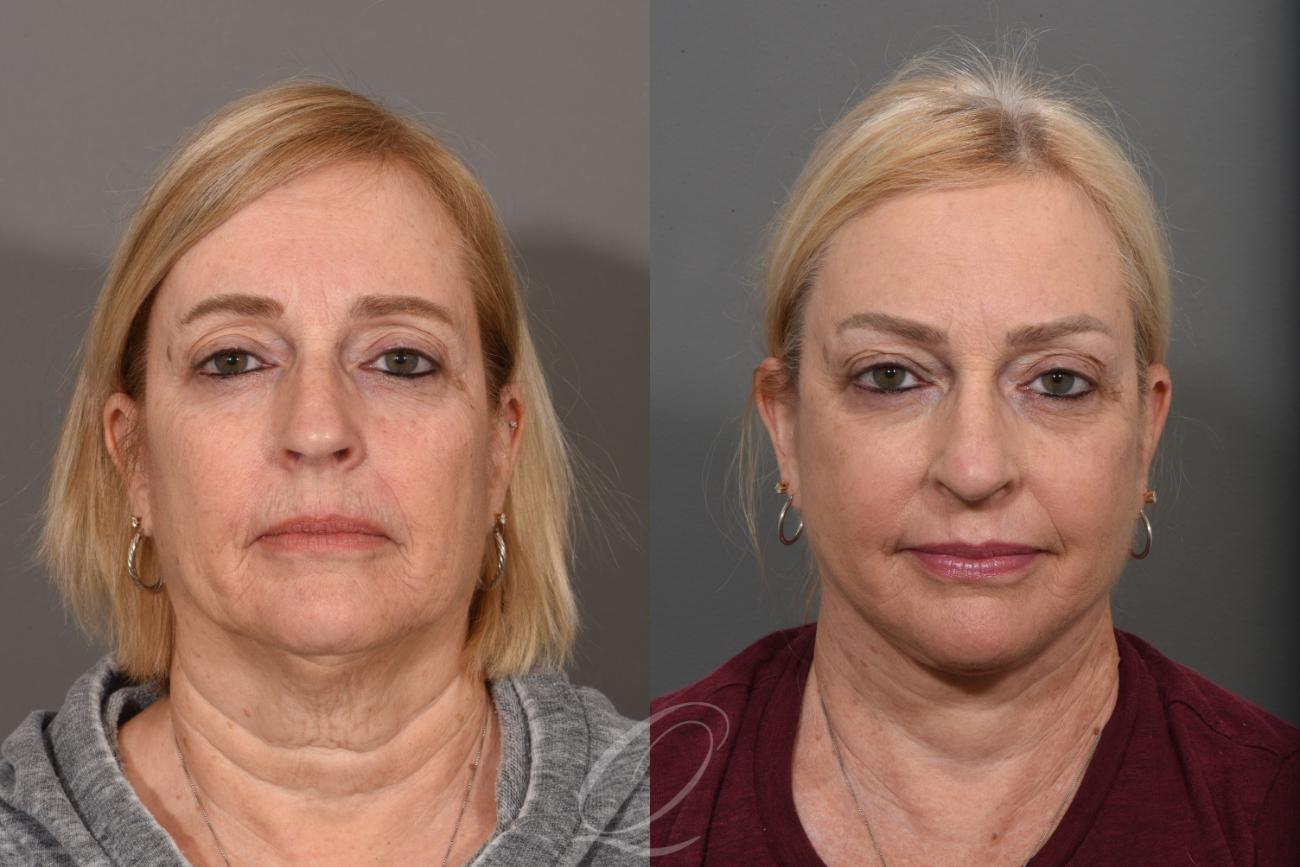 Skin Resurfacing Case 1422 Before & After Front | Serving Rochester, Syracuse & Buffalo, NY | Quatela Center for Plastic Surgery