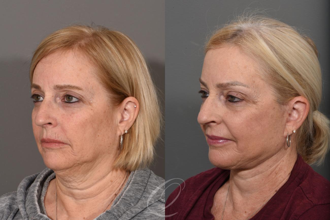 Skin Resurfacing Case 1422 Before & After Left Oblique | Serving Rochester, Syracuse & Buffalo, NY | Quatela Center for Plastic Surgery