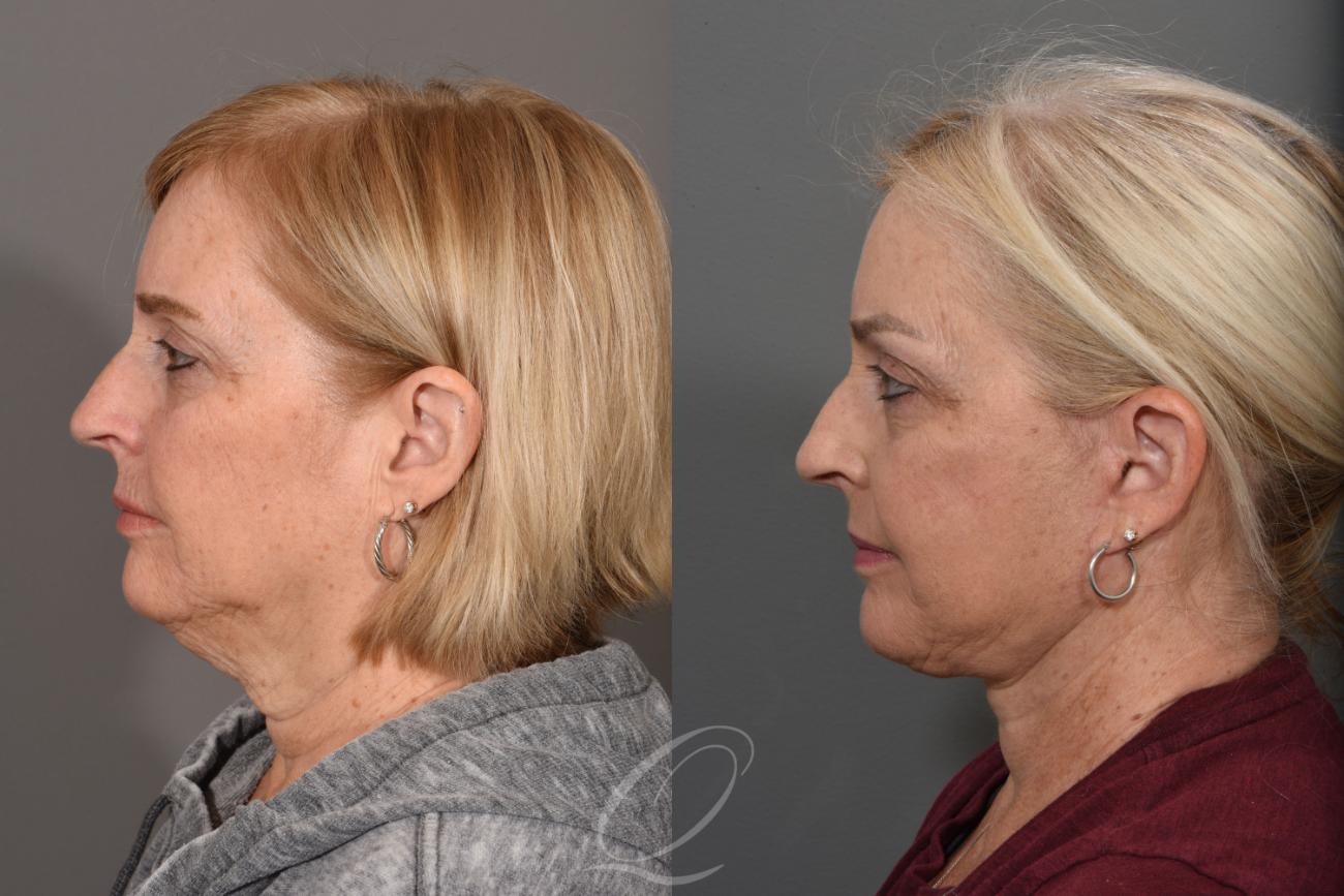 Skin Resurfacing Case 1422 Before & After Left Side | Serving Rochester, Syracuse & Buffalo, NY | Quatela Center for Plastic Surgery