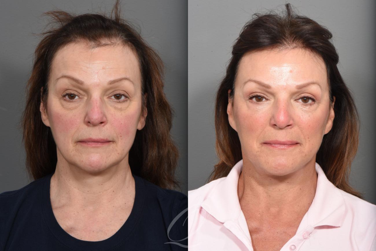 Facelift Case 1425 Before & After Front | Serving Rochester, Syracuse & Buffalo, NY | Quatela Center for Plastic Surgery