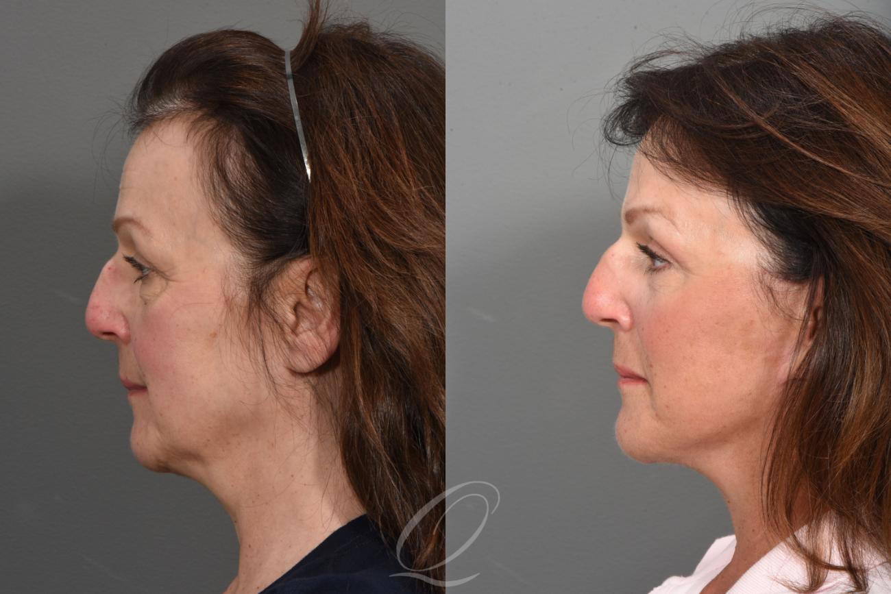 Facelift Case 1425 Before & After Left Side | Serving Rochester, Syracuse & Buffalo, NY | Quatela Center for Plastic Surgery