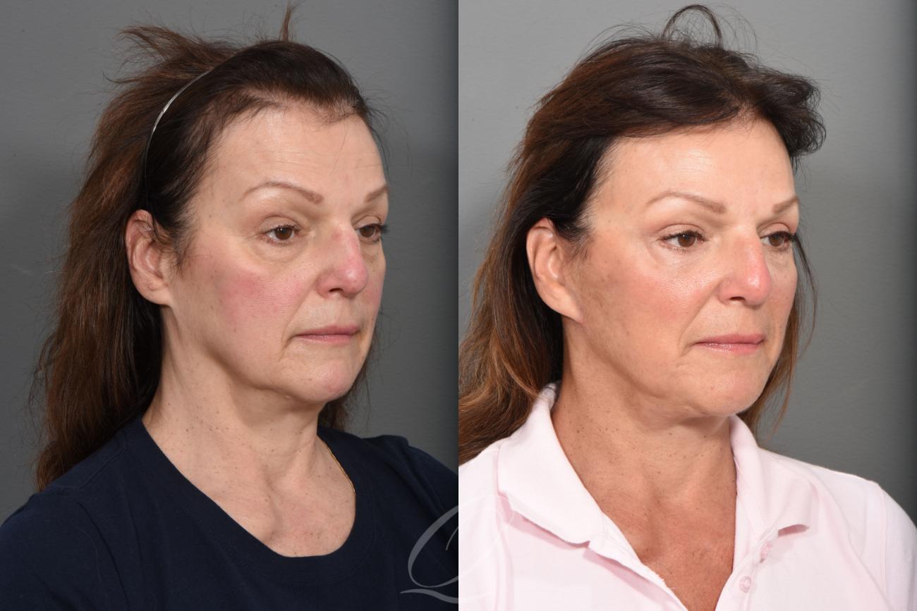 Facelift Case 1425 Before & After Right Oblique | Serving Rochester, Syracuse & Buffalo, NY | Quatela Center for Plastic Surgery