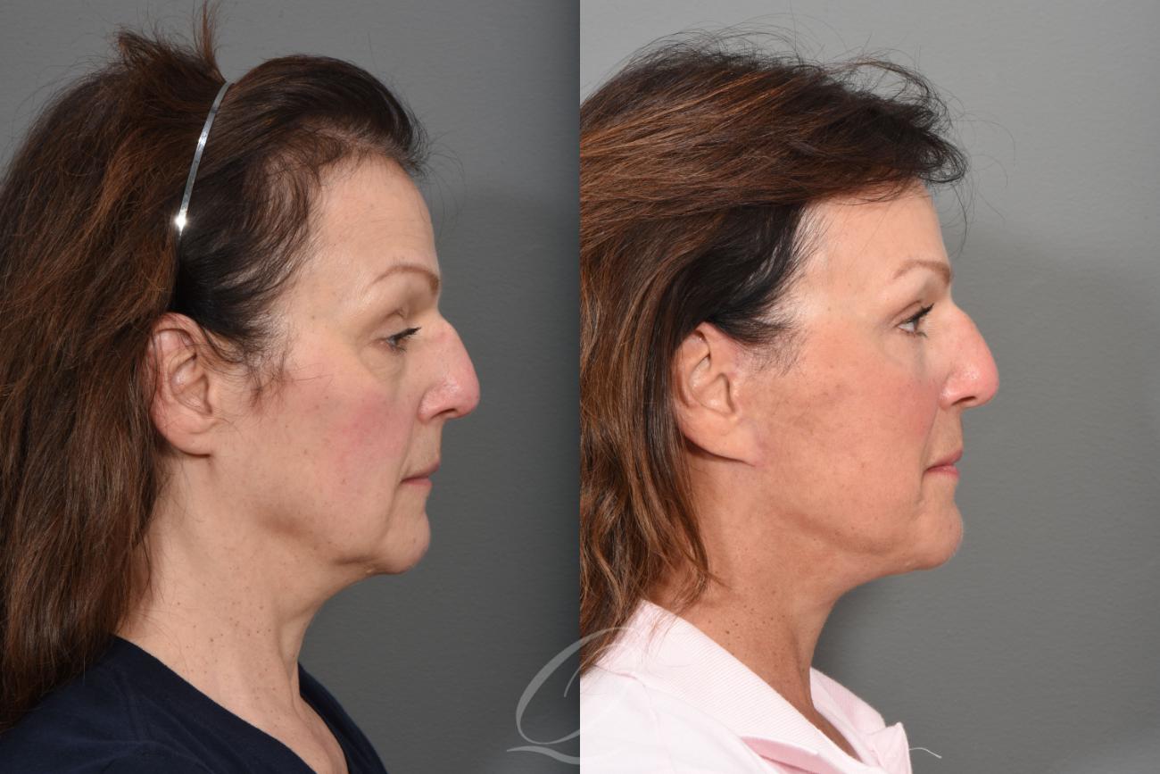 Facelift Case 1425 Before & After Right Side | Serving Rochester, Syracuse & Buffalo, NY | Quatela Center for Plastic Surgery