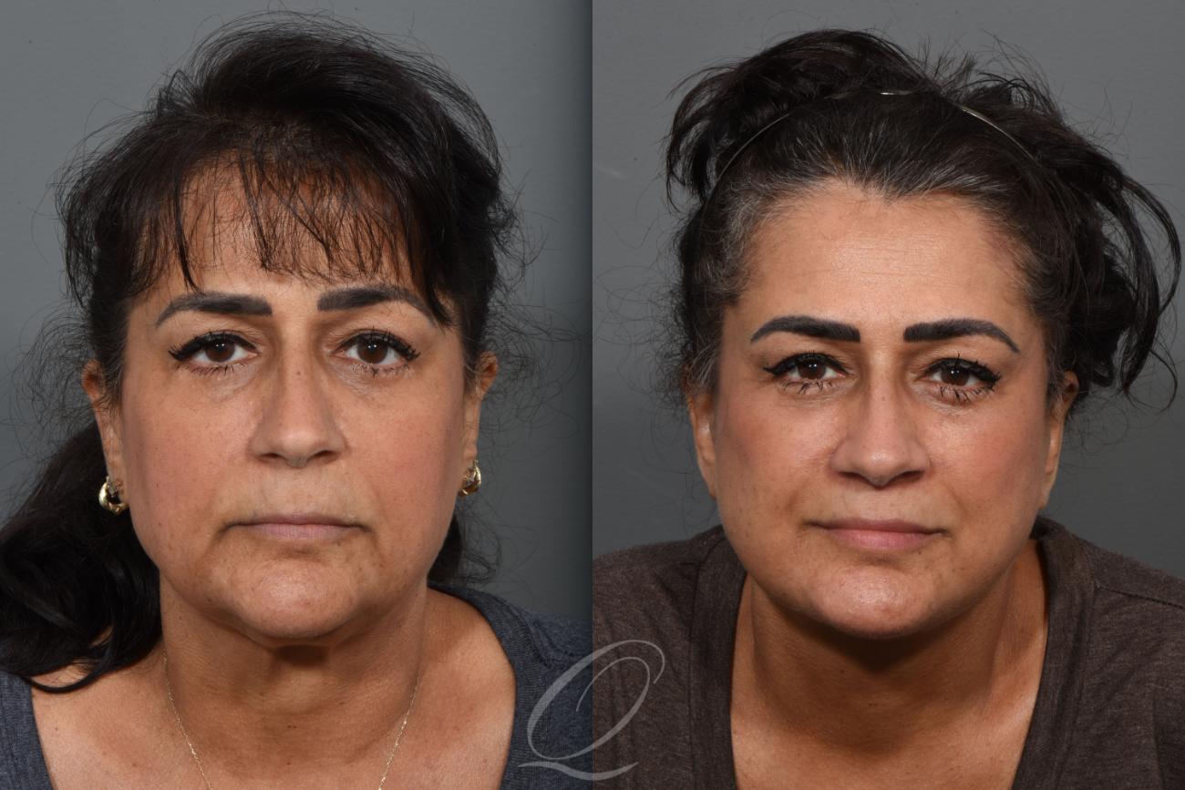 Lip Lift Case 1426 Before & After Front | Serving Rochester, Syracuse & Buffalo, NY | Quatela Center for Plastic Surgery