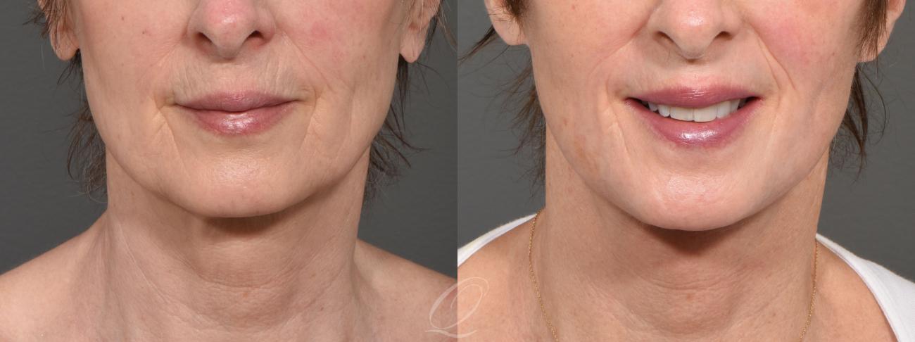 Skin Resurfacing Case 1429 Before & After Front | Serving Rochester, Syracuse & Buffalo, NY | Quatela Center for Plastic Surgery