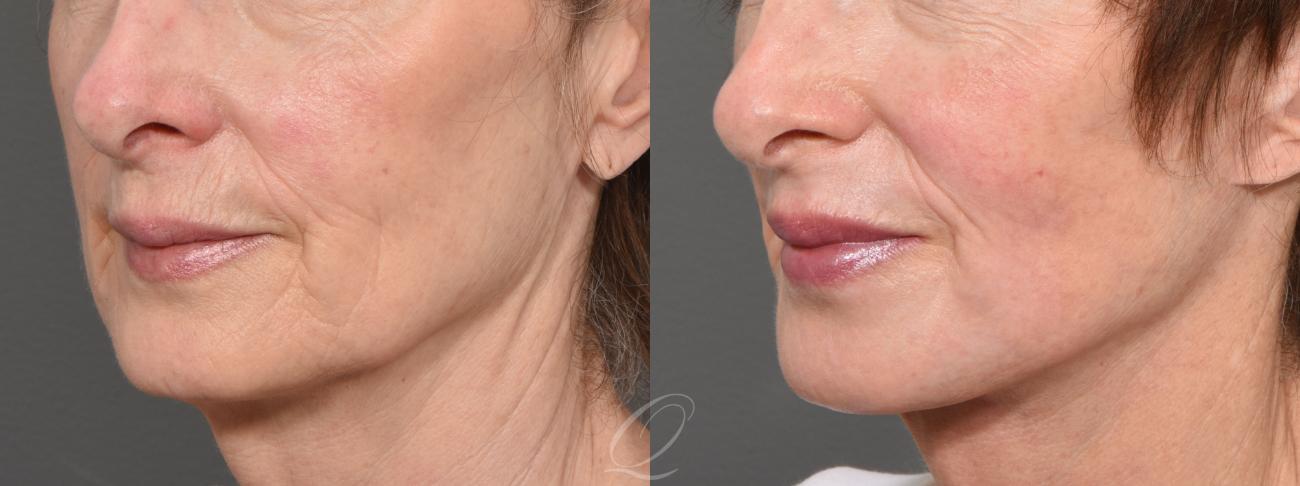 Facelift Case 1001429 Before & After Left Oblique | Serving Rochester, Syracuse & Buffalo, NY | Quatela Center for Plastic Surgery