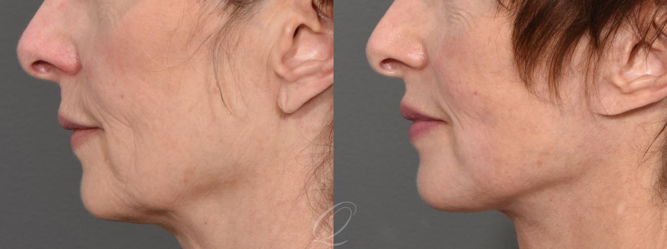 Skin Resurfacing Case 1429 Before & After Left Side | Serving Rochester, Syracuse & Buffalo, NY | Quatela Center for Plastic Surgery