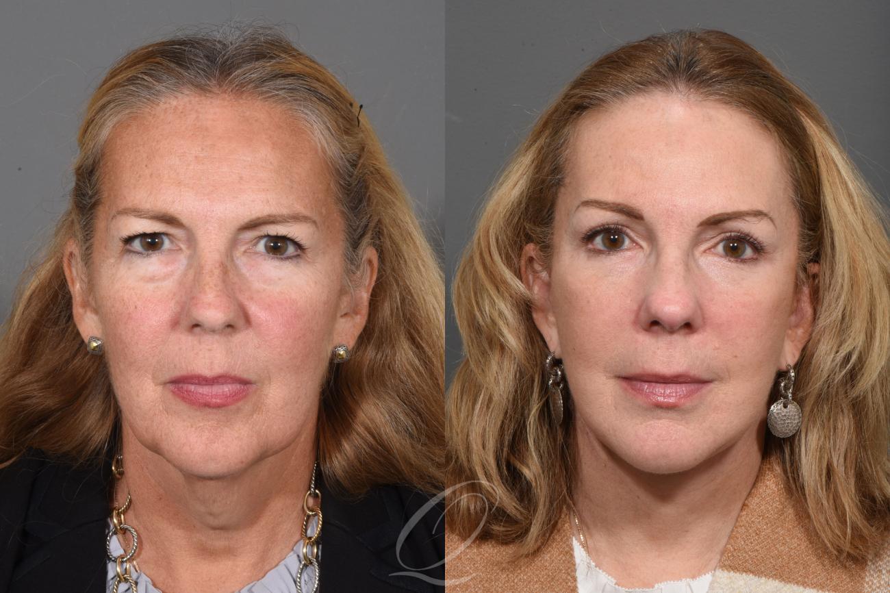 Eyelid Lift Case 1461 Before & After Front | Serving Rochester, Syracuse & Buffalo, NY | Quatela Center for Plastic Surgery