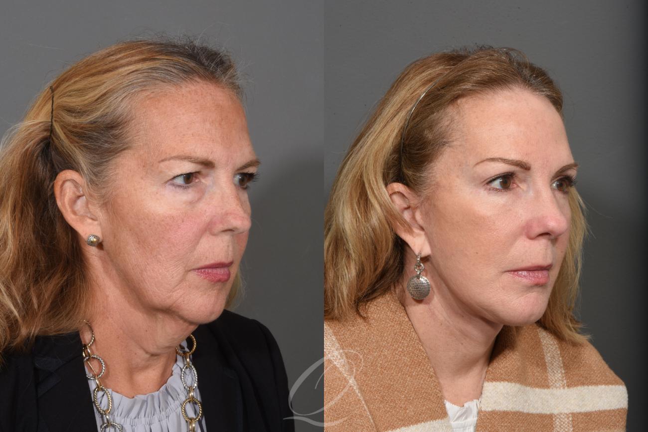 Facelift Case 1461 Before & After Right Oblique | Serving Rochester, Syracuse & Buffalo, NY | Quatela Center for Plastic Surgery