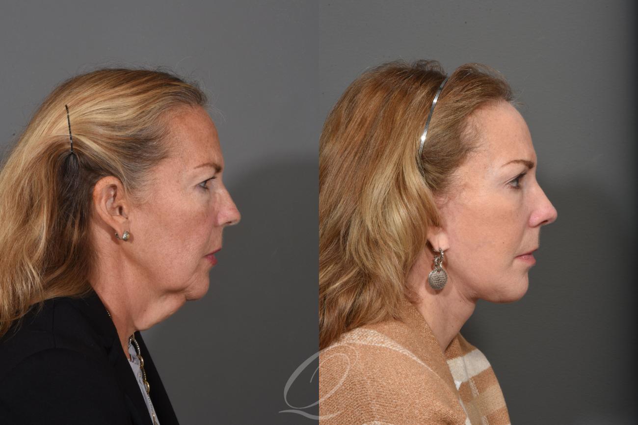 Facelift Case 1461 Before & After Right Side | Serving Rochester, Syracuse & Buffalo, NY | Quatela Center for Plastic Surgery