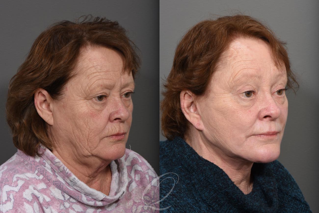 Skin Resurfacing Case 1466 Before & After Right Oblique | Serving Rochester, Syracuse & Buffalo, NY | Quatela Center for Plastic Surgery