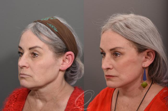 Facelift Case 1001504 Before & After Left Oblique | Serving Rochester, Syracuse & Buffalo, NY | Quatela Center for Plastic Surgery