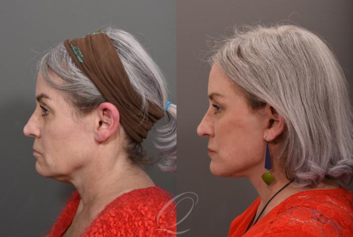 Facelift Case 1001504 Before & After Left Side | Serving Rochester, Syracuse & Buffalo, NY | Quatela Center for Plastic Surgery
